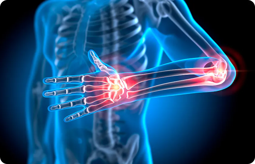 Die 3-Stufen-Formel gegen Arthrose